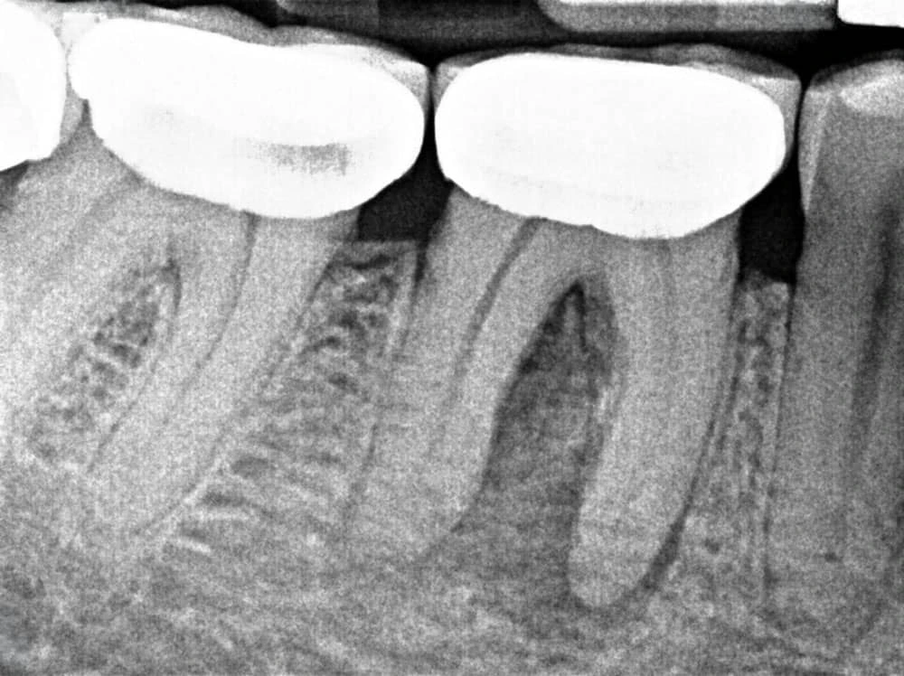 Diente antes de tratamiento de conducto en clínica de endodoncia en Querétaro